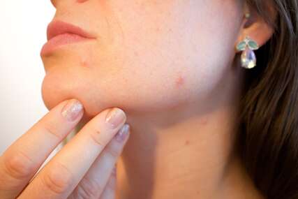 Dermatolozi ukazali na dvije namirnice koje dovode do upale i čine kožu starijom